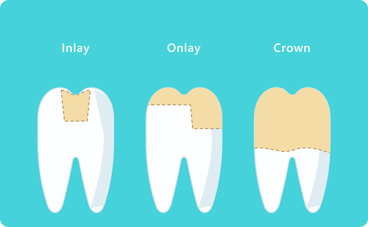 Diagram comparing a porcelain inlay, onlay and full crown, showing how much of the tooth each one covers